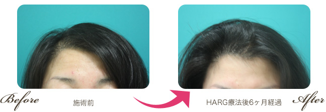 40歳女性/治療開始前　→　ハーグ療法開始後6か月