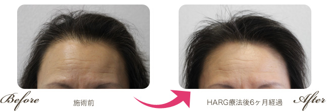 55歳女性/治療開始前　→　ハーグ療法開始後6か月