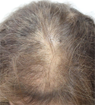 女性男性型脱毛症（FAGA）の状態