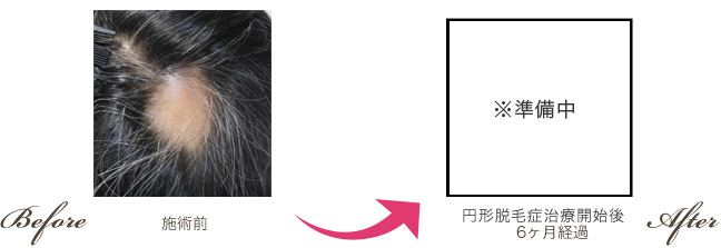 46歳女性/治療開始前　→　円形脱毛治療開始後6か月