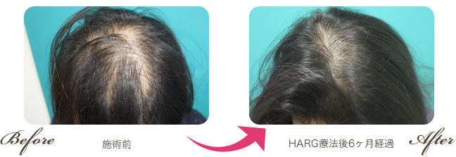 39歳女性/治療開始前　→　ハーグ療法開始後6か月