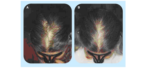 ヘアーバースサプリメント飲用前と飲用後の毛髪の全体量を比較した写真